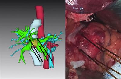 Irreversible Electroporation Treatment With Intraoperative Biliary Stenting for Unresectable Perihilar Cholangiocarcinoma: A Pilot Study